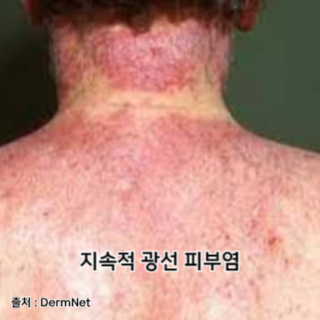 햇빛-알레르기-증상