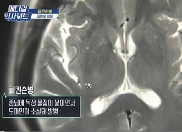 파킨슨병-정의