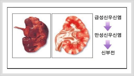 급성 신우신염 증상
