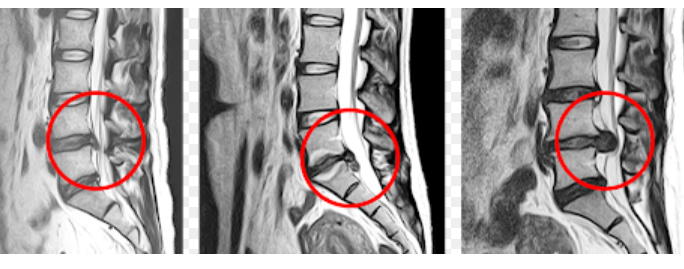 허리디스크 증상