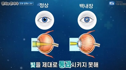 백내장설명