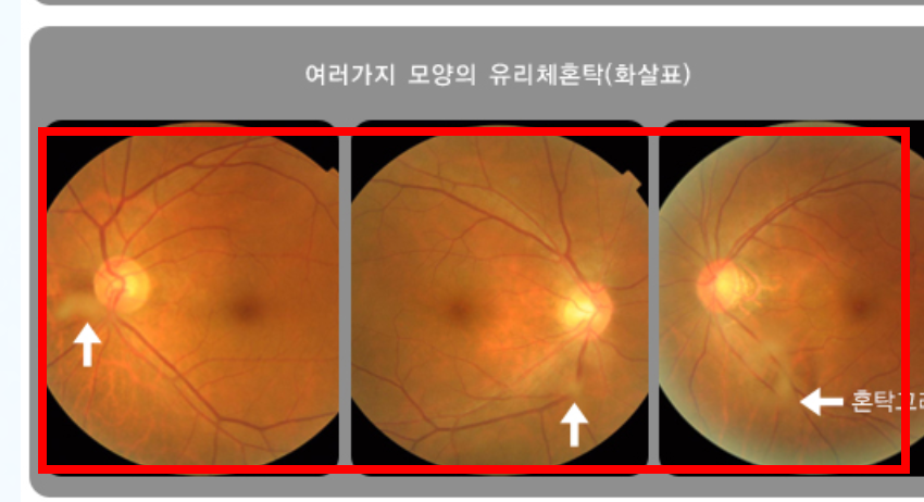비문증 치료방법 알아보기