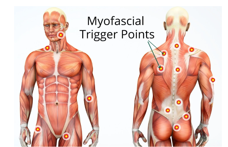 트리거 포인트 신체 위치 이미지