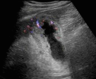 급성 담낭염 (Acute cholecystitis)