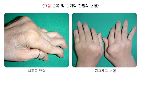 류마티스관절염-원인,-증상,-예방,-치료방법