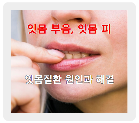 잇몸 부음, 피, 내려앉음, 건강한 잇몸을 위한 비결 대공개