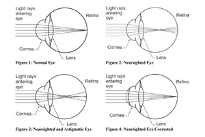라식 라섹 차이