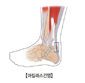 아킬레스건염