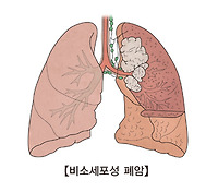 폐암 초기증상