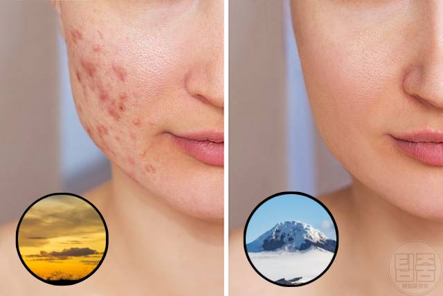 성인여드름 원인 갑자기 여드름 나는 이유