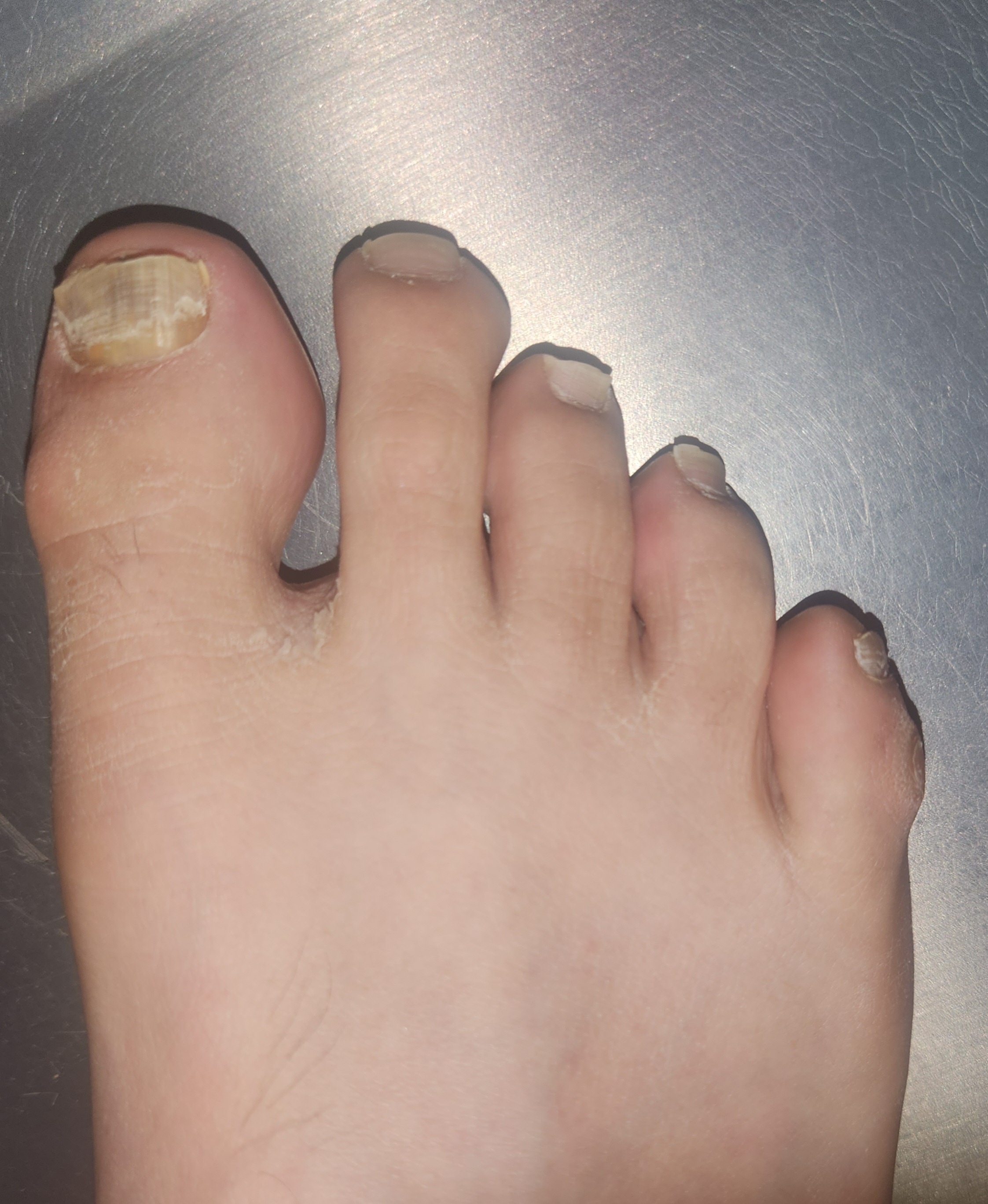 내성발톱 및 무좀