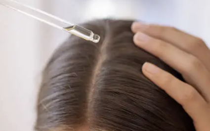 두피 가려움증 원인 3