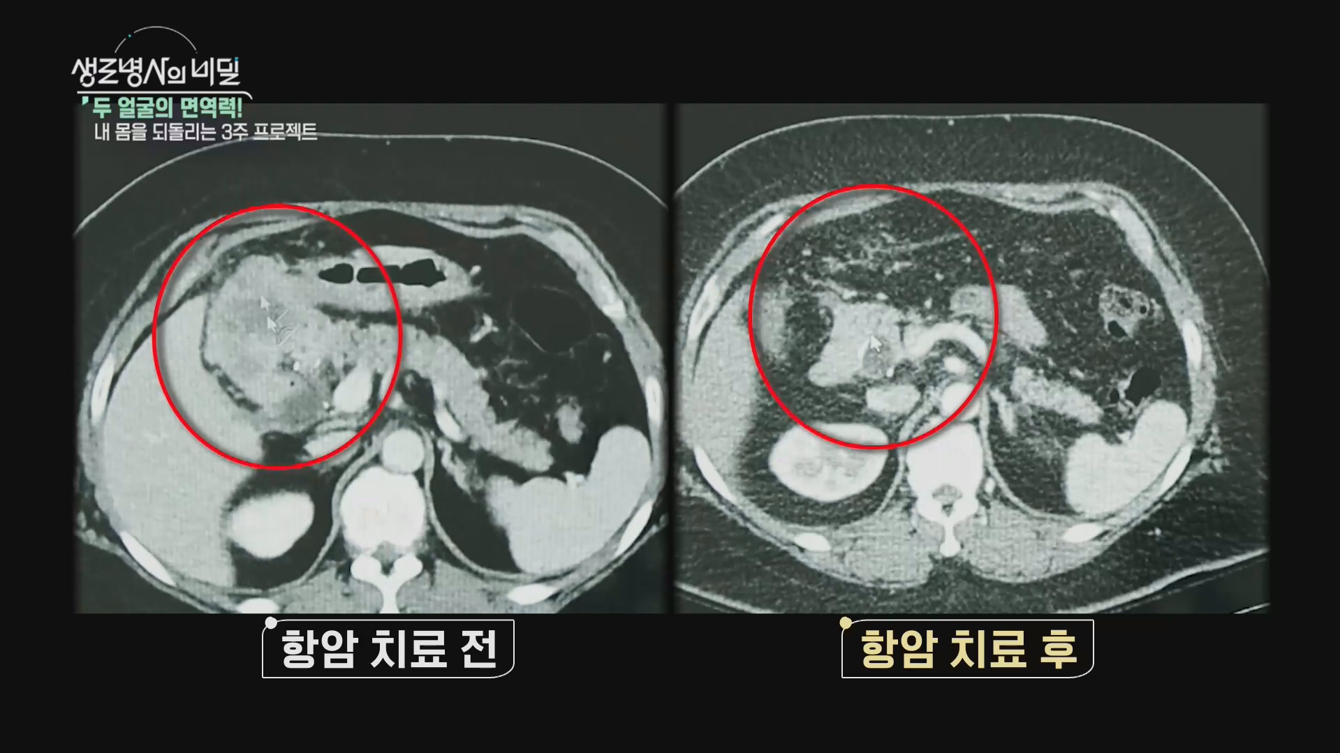 생로병사의 비밀 두 얼굴의 면역력