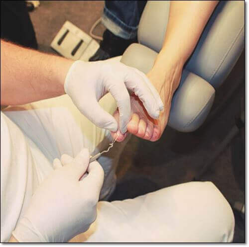 내성발톱 치실 치료