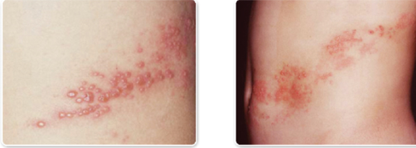 대상포진 원인과 증상. 피부염증 사진