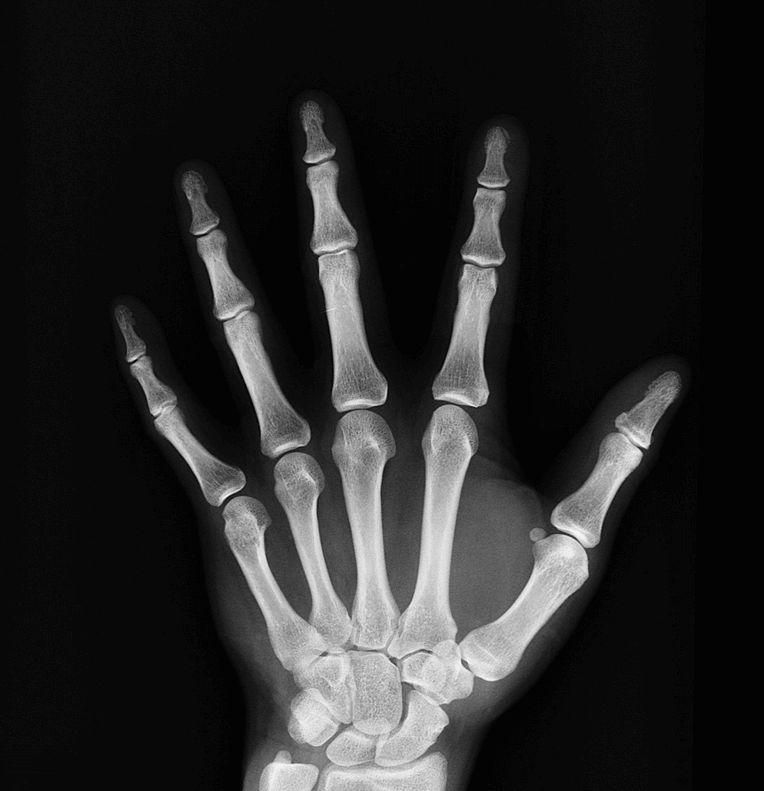 칼슘 부족과 관련된 사진 - 8