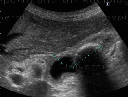 만성 담낭염 (Chronic cholecystitis)