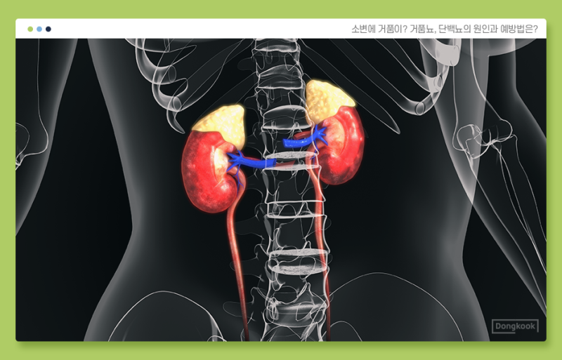 소변 거품(거품뇨)란