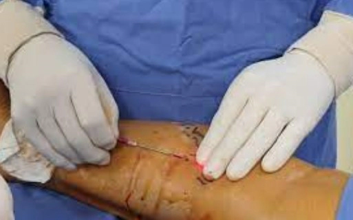 하지정맥류 발거술 치료법
