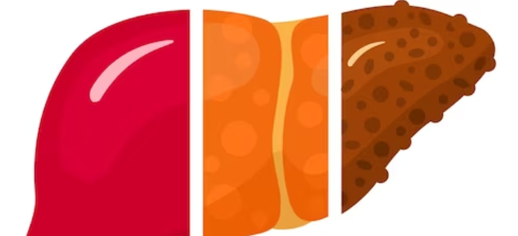 지방간 질환의 장기적인 영향은 무엇인가?