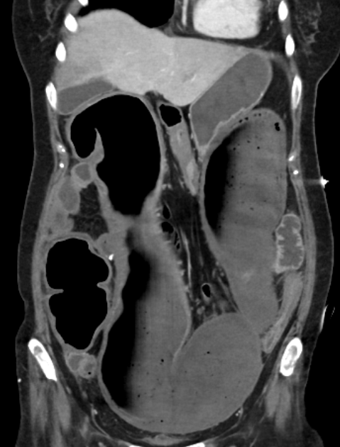 Toxic megacolon CT