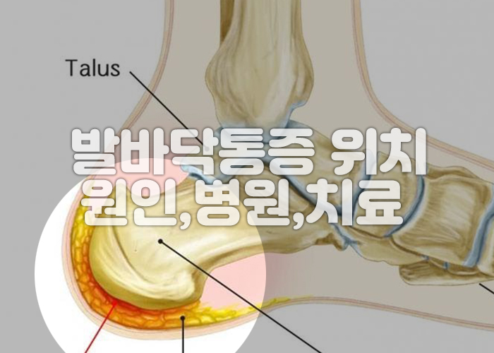 뒤꿈치 지방패드 위축 이미지