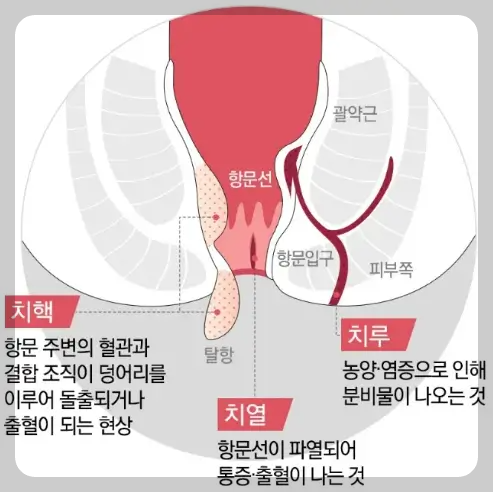 내치질 외치질 증상 차이