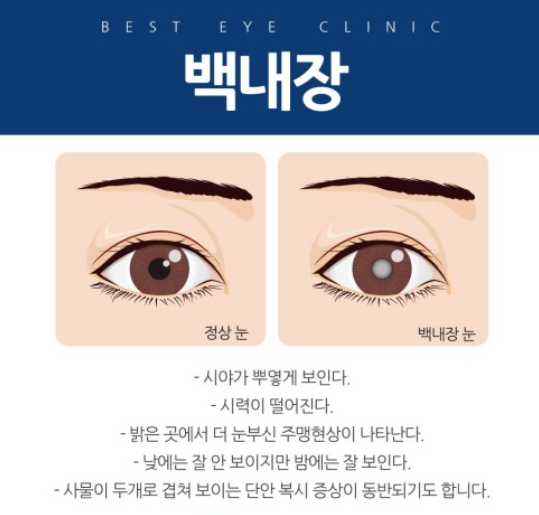 백내장