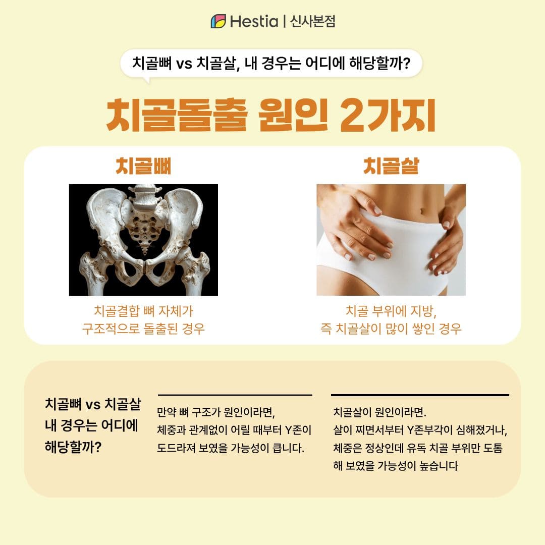 치골돌출, '뼈'일까 '살'일까? 자가진단법