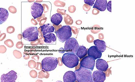 혈핵학-소아 급성림프구성백혈병(ALL)에서 표적치료제 적용 사례