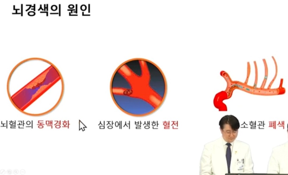 뇌경색원인