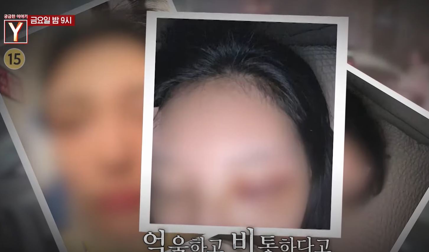 풀스윙펀치에 코뼈가 부러진 배우 지망생