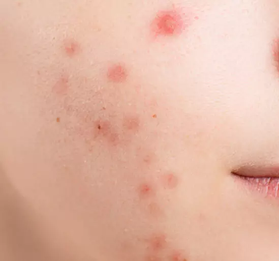 대상포진-초기증상-원인-건강