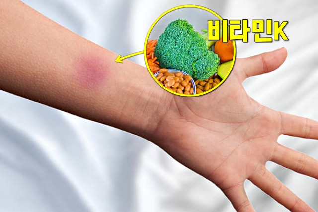 야채 섭취 부족 증상, 멍이 잘드는 이유, 채소 섭취 부족 증상, 팁줌