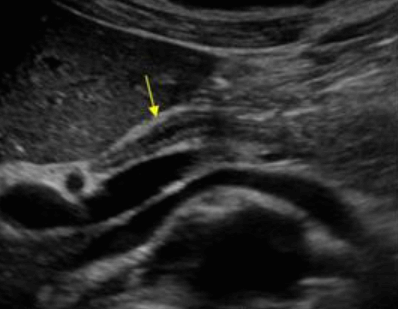 담관염(Cholangitis)
