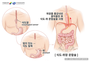 식도암