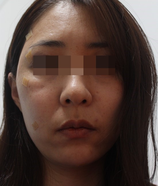 얼굴지방이식후기