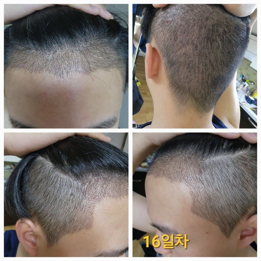 모발이식 후기