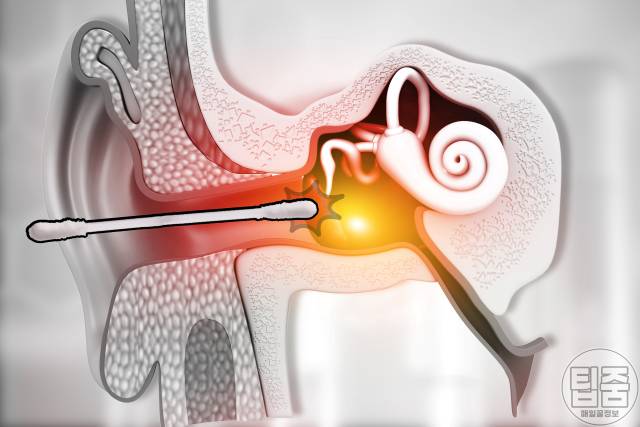 청력 좋아지는 법 청력손실 면봉 고막