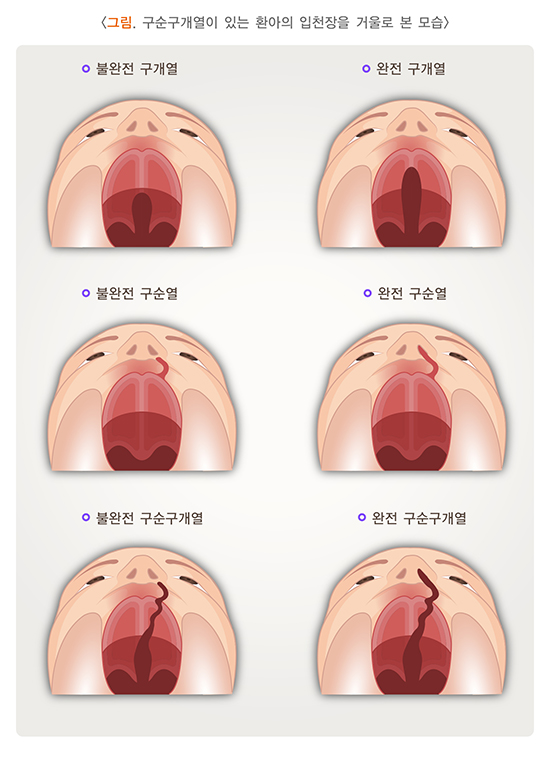 구개열 입천장 이미지