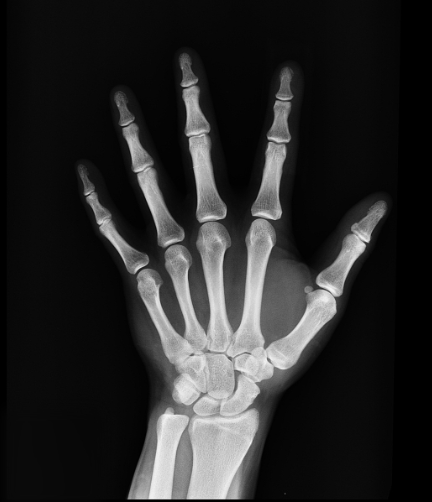 골다공증 주사 (6개월 주기와 종류)