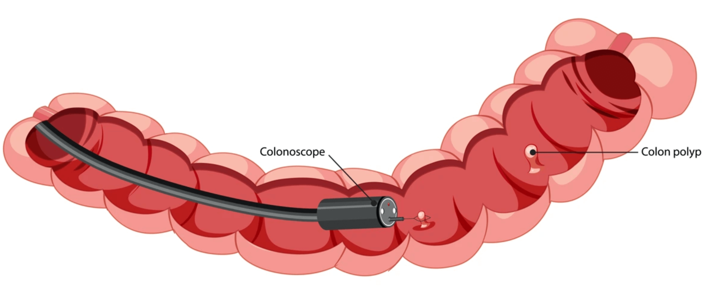 대장내시경 용종제거 비용