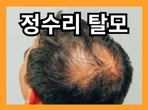 머리카락이 많이 빠지는 이유 - 정수리 탈모