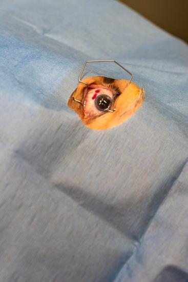 안구내 주사(Intravitreal Injection) &ndash; 눈 속 주사 치료법