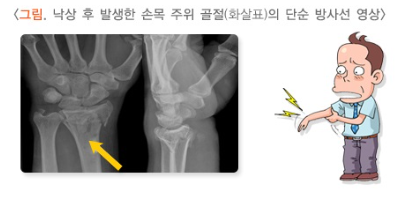 낙상 골절