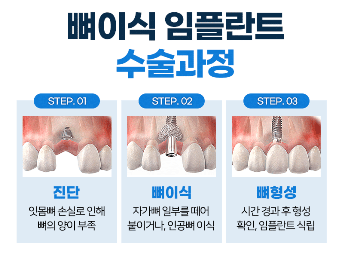 임플란트 부작용