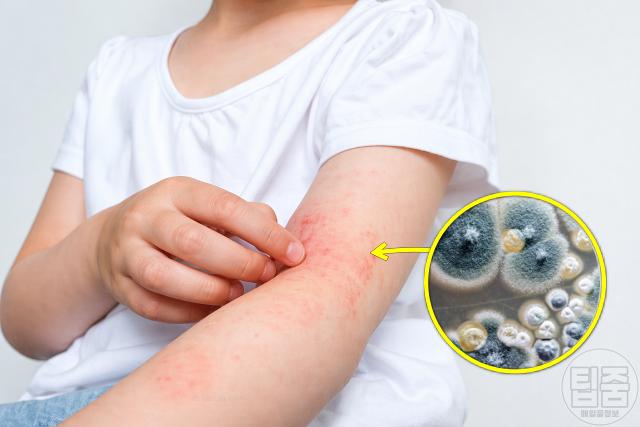 알레르기 비염 가려움증 아이