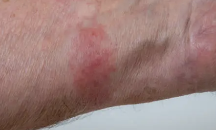 몸이 가려운 이유 16