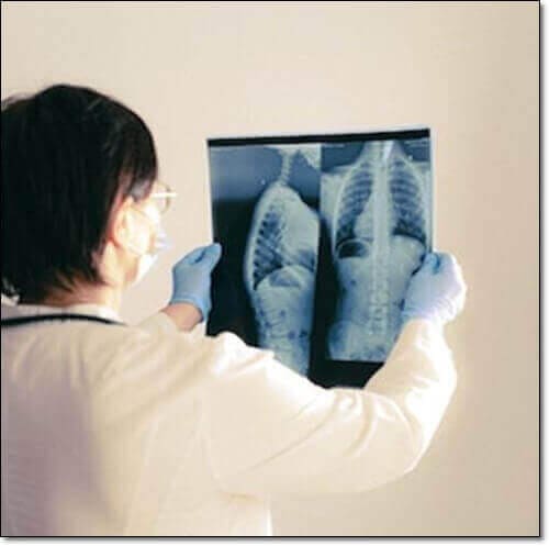 기흉 진단 및 치료 관리, 엑스선 필름 보는 의사 사진