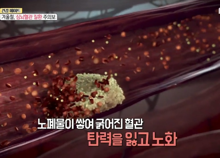 EBS-명의-심뇌혈관질환-오성진-교수